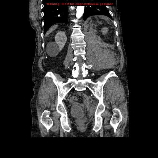 Abdominal aortic aneurysm- extremely large, ruptured (Radiopaedia 19882-19921 Coronal C+ arterial phase 74).jpg