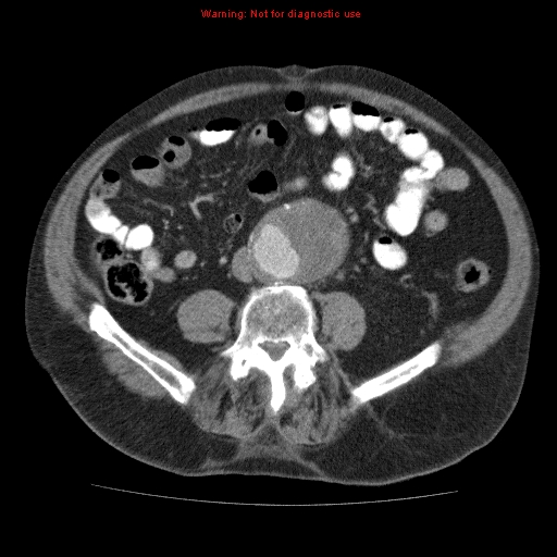 File:Abdominal aortic aneurysm (Radiopaedia 10122-10660 Axial C+ portal venous phase 49).jpg