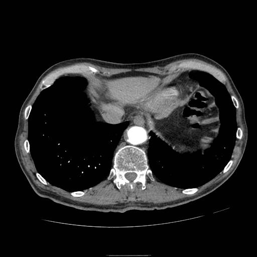 Abdominal aortic aneurysm (Radiopaedia 13341-13340 Axial C+ arterial phase 13).jpg
