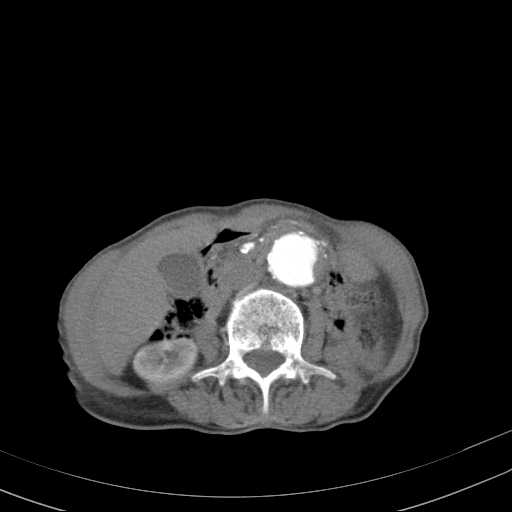 File:Abdominal aortic aneurysm (Radiopaedia 20827-20742 Axial C+ arterial phase 17).jpg
