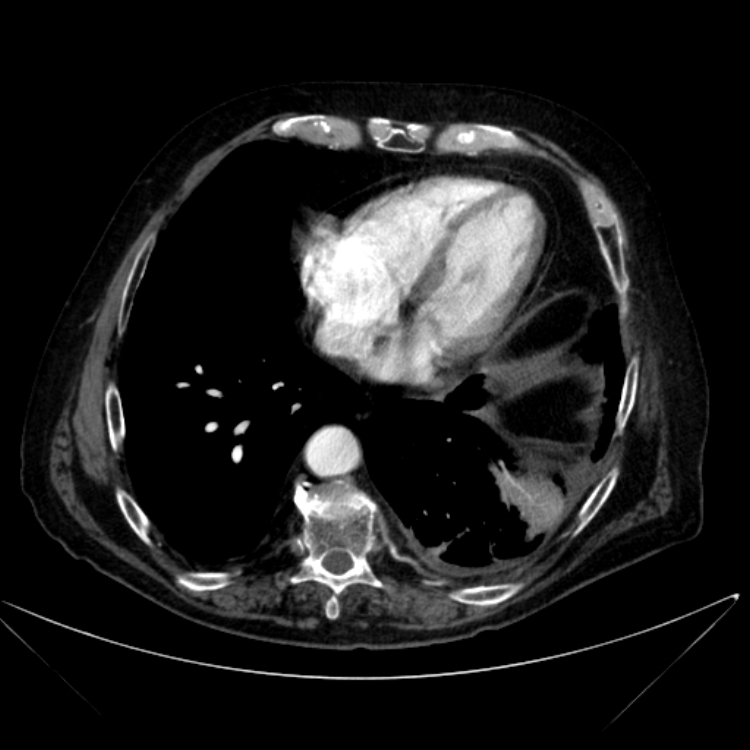 Abdominal aortic aneurysm (Radiopaedia 25855-26001 Axial C+ arterial phase 12).jpg