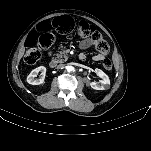 Abdominal aortic aneurysm (Radiopaedia 67117-76452 Axial C+ arterial phase 60).jpg