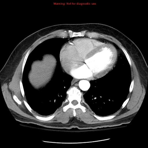 Abdominal aortic aneurysm (Radiopaedia 8190-9038 Axial C+ arterial phase 3).jpg