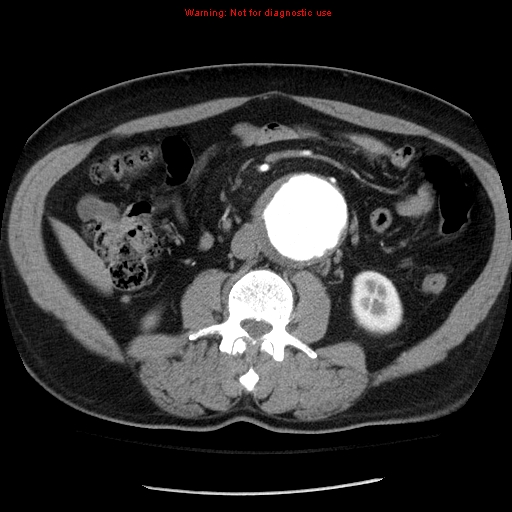 Abdominal aortic aneurysm (Radiopaedia 8190-9038 Axial C+ arterial phase 41).jpg