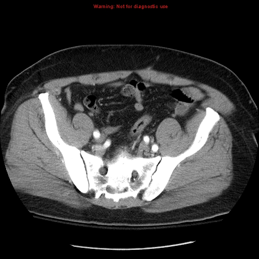 Abdominal aortic aneurysm (Radiopaedia 8190-9038 Axial C+ arterial phase 65).jpg