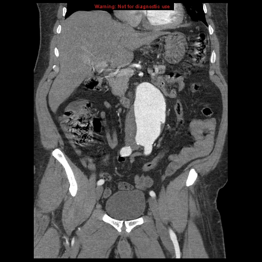 Abdominal aortic aneurysm (Radiopaedia 8190-9038 Coronal C+ arterial phase 53).jpg