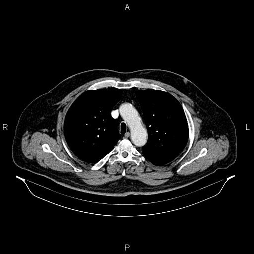 Abdominal aortic aneurysm (Radiopaedia 83094-97462 Axial renal cortical phase 24).jpg