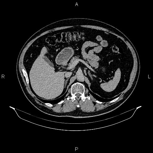 Abdominal aortic aneurysm (Radiopaedia 83094-97462 Axial renal excretory phase 36).jpg