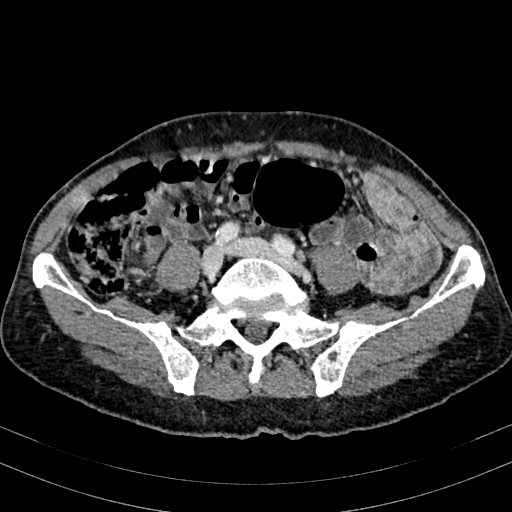 Abdominal aortic aneurysm (Radiopaedia 83581-98689 Axial C+ portal venous phase 76).jpg