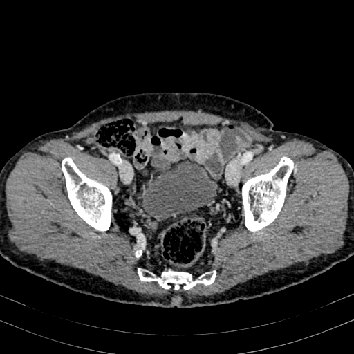 File:Abdominal aortic aneurysm (Radiopaedia 83581-98689 Axial C+ portal venous phase 97).jpg