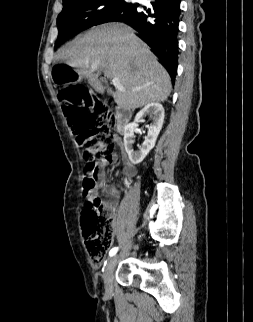 Abdominal aortic aneurysm (Radiopaedia 83581-98689 Sagittal C+ arterial phase 2).jpg