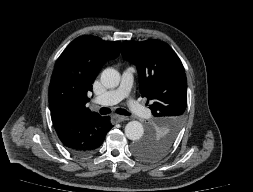 Abdominal aortic aneurysm rupture (Radiopaedia 54179-60362 Axial C+ portal venous phase 44).jpg