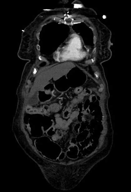 Abdominal aortic aneurysm with thrombus fissuration (Radiopaedia 73192-83919 Coronal C+ arterial phase 6).jpg