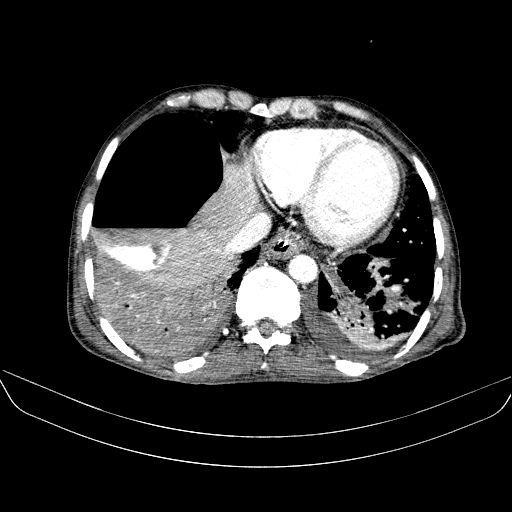 File:Abdominal collection due to previous cecal perforation (Radiopaedia 80831-94320 Axial C+ portal venous phase 17).jpg