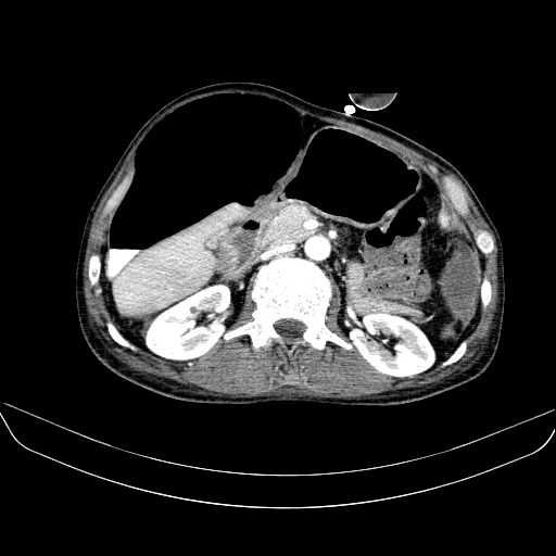 File:Abdominal collection due to previous cecal perforation (Radiopaedia 80831-94320 Axial C+ portal venous phase 78).jpg
