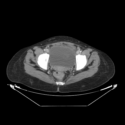 Abdominal gossypiboma- surgical towel (Radiopaedia 57288-64226 Axial C+ portal venous phase 68).jpg