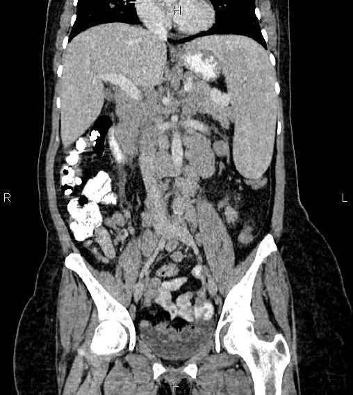 Abdominal lymphoma with sandwich sign (Radiopaedia 84378-99704 Coronal C+ portal venous phase 31).jpg
