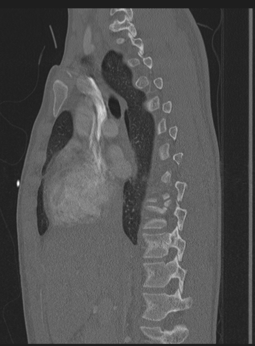 Abdominal multi-trauma - devascularised kidney and liver, spleen and pancreatic lacerations (Radiopaedia 34984-36486 Sagittal bone window 44).png