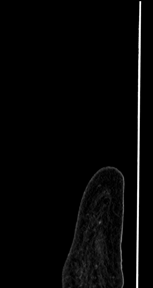 Abdominal wall and retroperitoneal tuberculosis (Radiopaedia 88137-104729 Sagittal C+ portal venous phase 1).jpg