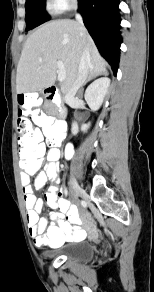 Abdominal wall and retroperitoneal tuberculosis (Radiopaedia 88137-104729 Sagittal C+ portal venous phase 94).jpg