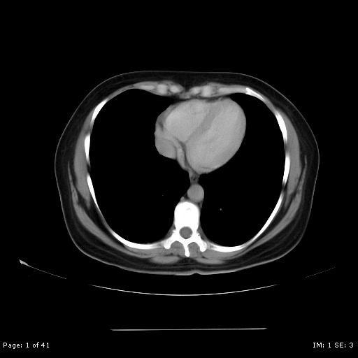 File:Abdominal wall endometriosis (Radiopaedia 25723-25885 Axial C+ portal venous phase 1).jpg