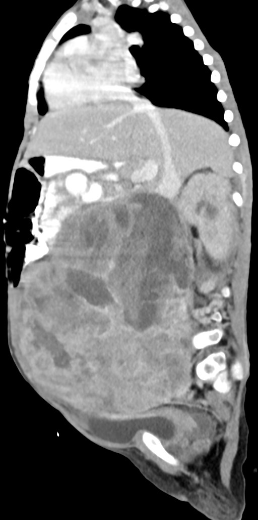 Abdominopelvic rhabdomyosarcoma (Radiopaedia 78356-90984 Sagittal C+ portal venous phase 54).jpg