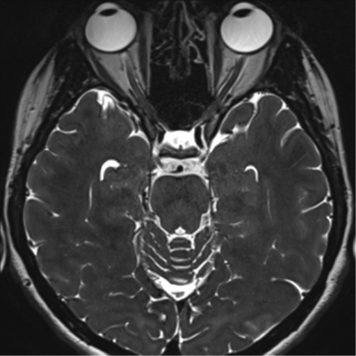 Abducens nerve palsy (Radiopaedia 51069-56648 Axial T2 fat sat 57).png