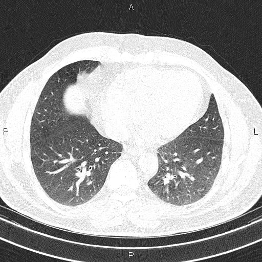 File:Aberrant right subclavian artery (Radiopaedia 87093-103354 Axial lung window 76).jpg