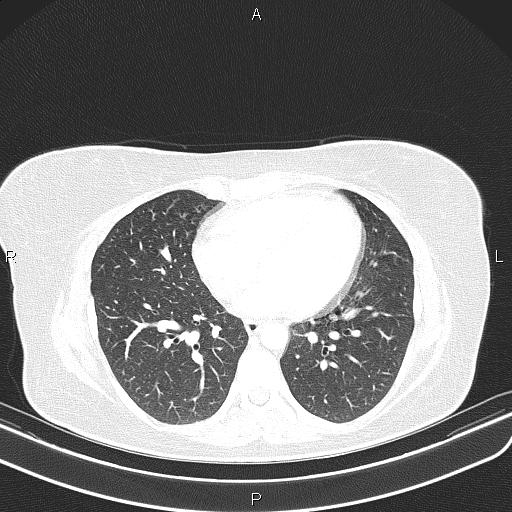 Aberrant right subclavian artery (Radiopaedia 87334-103629 Axial lung window 42).jpg