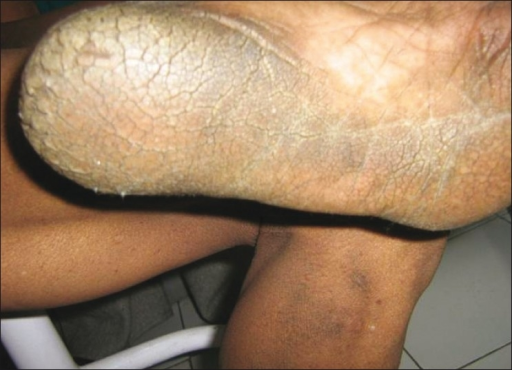File:Acanthosis palmaris and plantar keratoderma in metastatic carcinoma of the bladder.png