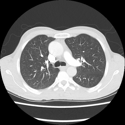 Accessory left horizontal fissure with lingular pneumonia (Radiopaedia 53763-59843 Axial lung window 23).jpg