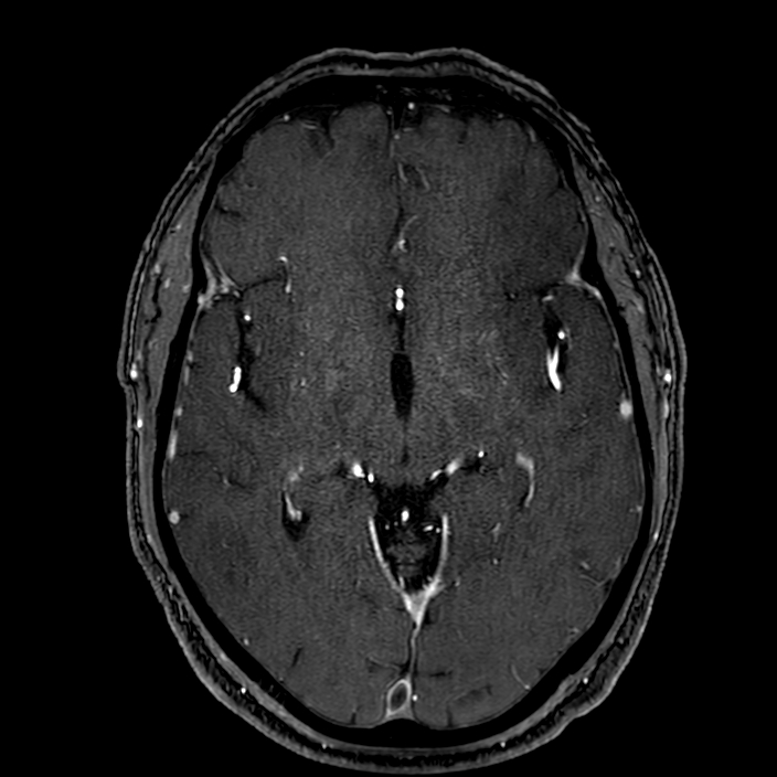 Accessory middle cerebral artery (Radiopaedia 73114-83828 Axial MRA 90).jpg