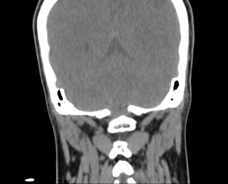Accessory parotid gland (Radiopaedia 76207-87772 Coronal non-contrast 114).jpg