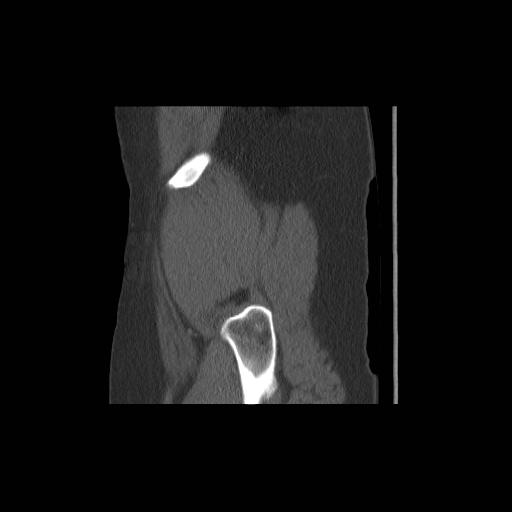 File:Acetabular fracture (Radiopaedia 13193-13212 Sagittal bone window 6).jpg