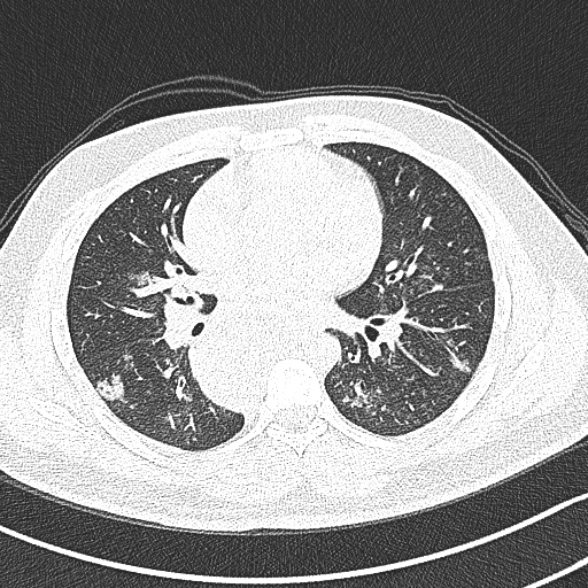 Achalasia with aspiration (Radiopaedia 55413-61845 Axial lung window 39).jpg