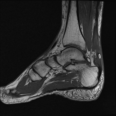 File:Achilles tendon tear (Radiopaedia 77615-89819 Sagittal T1 9).jpg