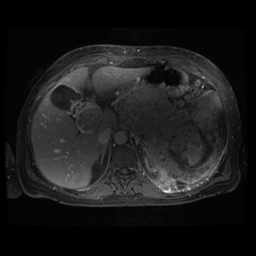 Acinar cell carcinoma of the pancreas (Radiopaedia 75442-86668 Axial T1 C+ fat sat 84).jpg