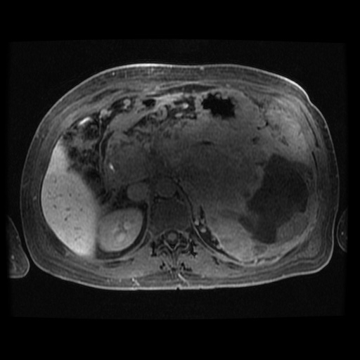 Acinar cell carcinoma of the pancreas (Radiopaedia 75442-86668 Axial late phase (~30 mins) 67).jpg