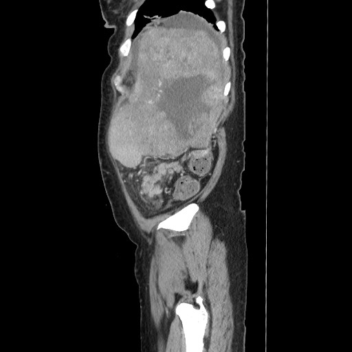 Acinar cell carcinoma of the pancreas (Radiopaedia 75442-86669 Sagittal C+ portal venous phase 164).jpg