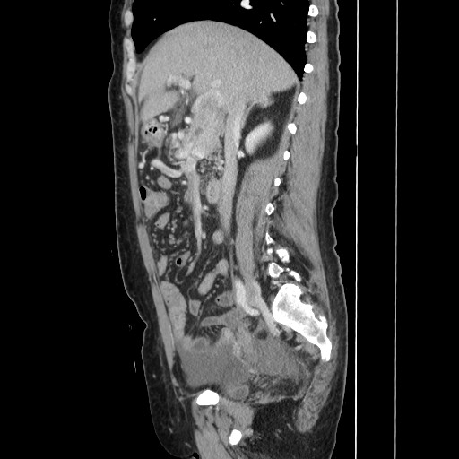 Acinar cell carcinoma of the pancreas (Radiopaedia 75442-86669 Sagittal C+ portal venous phase 81).jpg