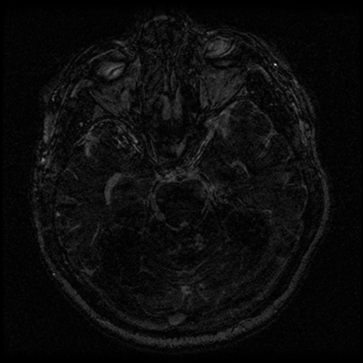 Acoustic schwannoma (Radiopaedia 33045-34060 Axial T2 72).png