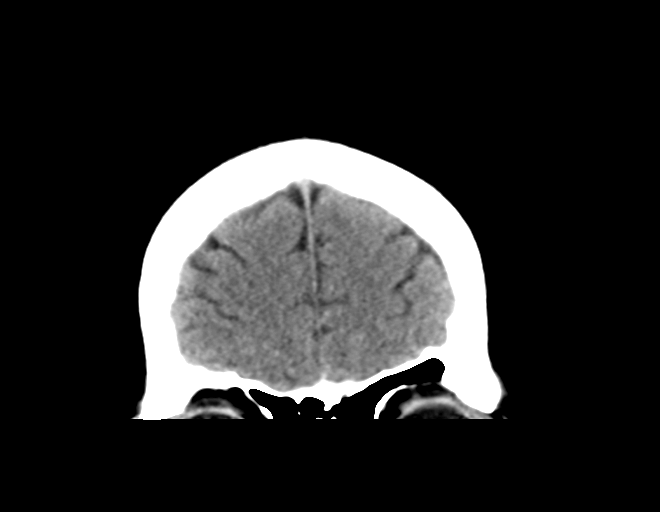File:Acoustic schwannoma (Radiopaedia 33045-34065 Coronal non-contrast 10).png