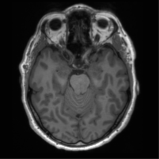 File:Acoustic schwannoma (Radiopaedia 50846-56358 Axial T1 40).png