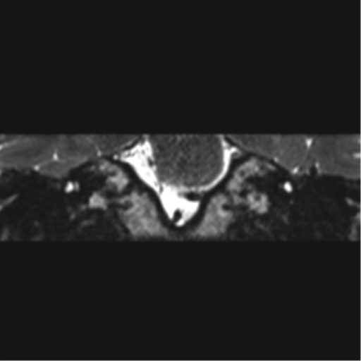 File:Acoustic schwannoma (Radiopaedia 50846-56358 Coronal T2 26).png