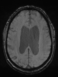 Acoustic schwannoma (Radiopaedia 55729-62281 Axial SWI 34).png