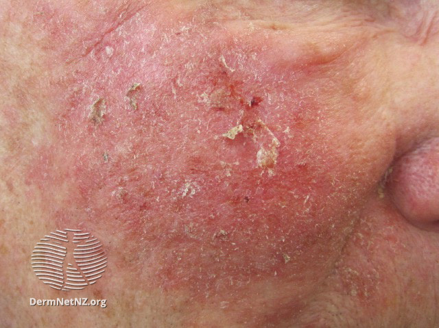 Actinic Keratoses affecting the face (DermNet NZ lesions-ak-face-304).jpg