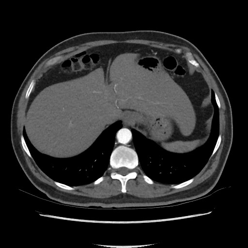 File:Active colonic bleed on CT (Radiopaedia 49765-55025 Axial C+ arterial phase 15).jpg