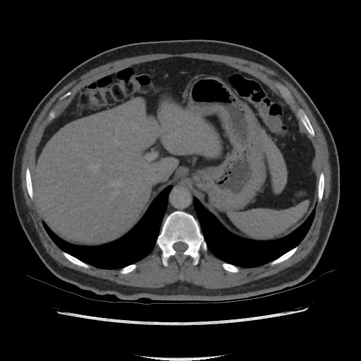 File:Active colonic bleed on CT (Radiopaedia 49765-55025 Axial C+ delayed 18).jpg