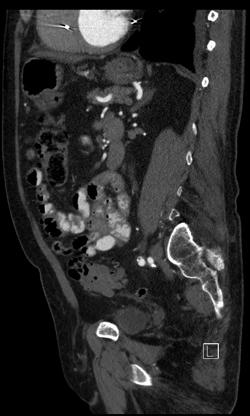 Active lower gastrointestinal bleeding - diverticular (Radiopaedia 61203-69106 Sagittal C+ arterial phase 63).jpg