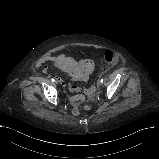 File:Active renal extravasation with large subcapsular and retroperitoneal hemorrhage (Radiopaedia 60975-68796 Axial C+ arterial phase 168).jpg